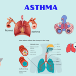 Asthma: Types, Causes, Symptoms, Diagnosis & Treatment