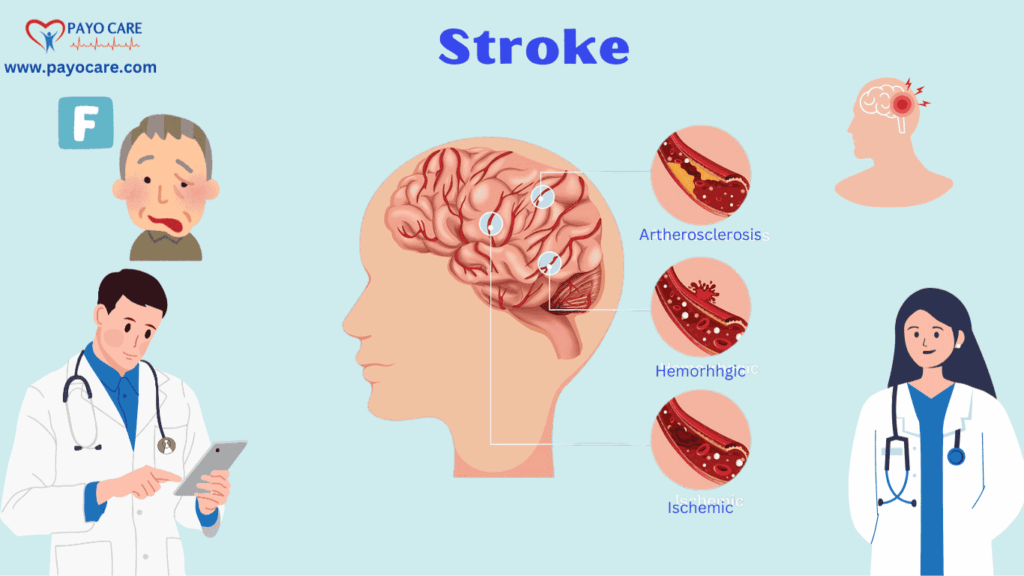 Stroke: Causes, Symptoms & Prevention Stroke: Causes, Symptoms & Prevention