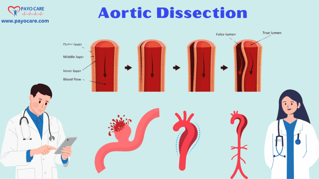 Aortic Dissection: Types, Causes and Treatment