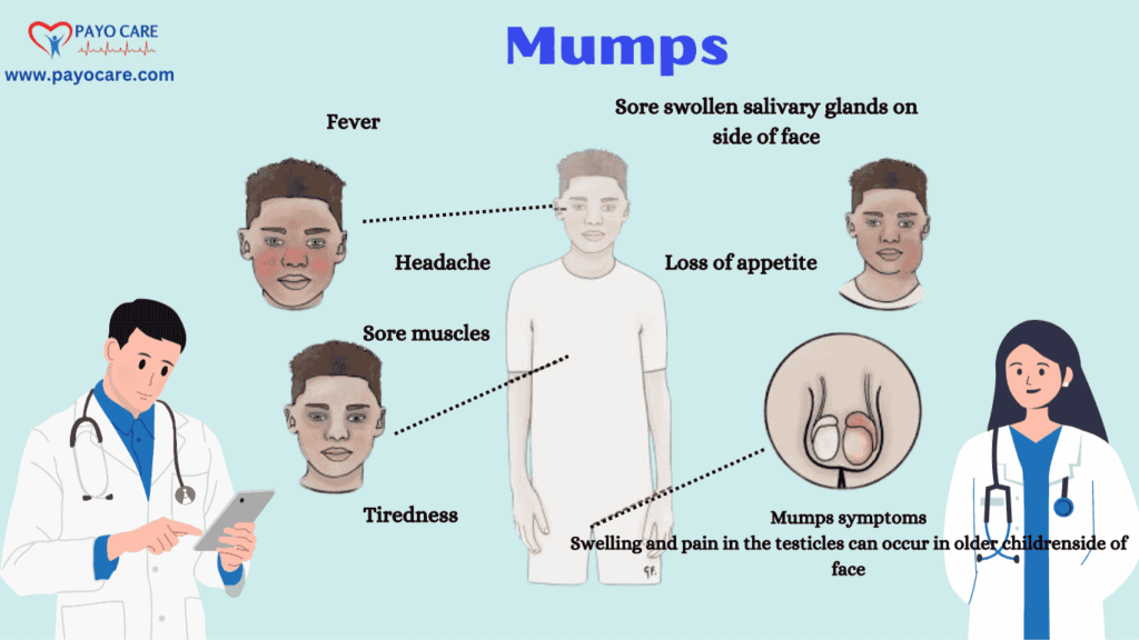 Mumps: Types, Causes, Symptoms, Prevention, Diagnosis, and Treatment