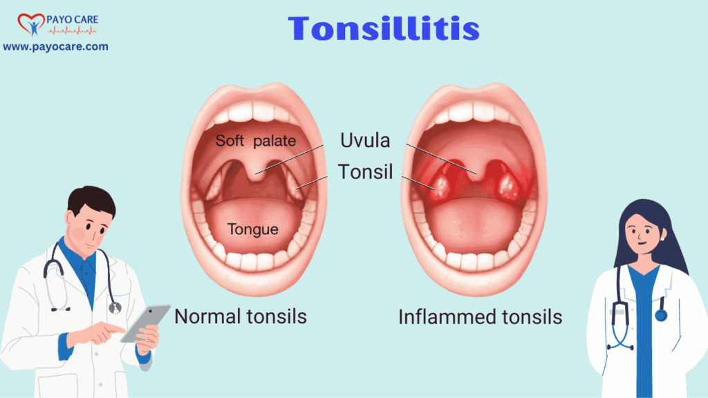 Tonsillitis: Types, Causes, Symptoms, Prevention, and Treatment Tonsillitis: Types, Causes, Symptoms, Prevention, and Treatment